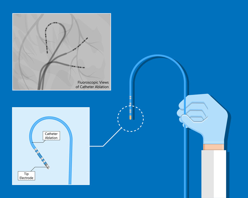 Catheter Ablation