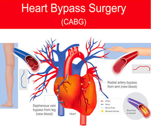 Heart Bypass Surgery