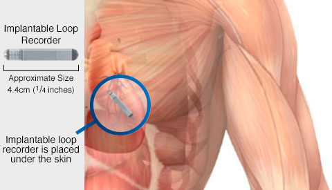 Implantable Loop Recorder (ILR)